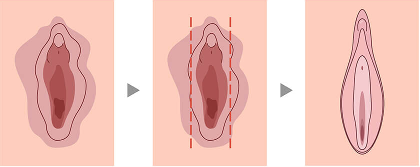 cirurgia íntima feminina antes e depois