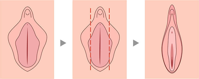 cirurgia íntima feminina antes e depois